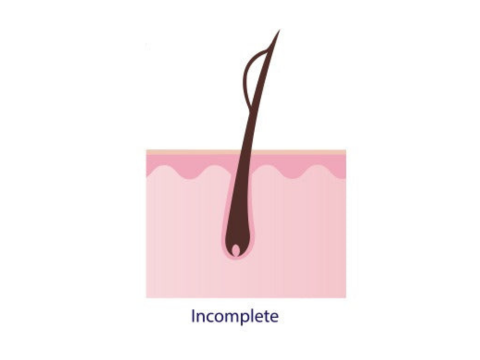 incomplete split end